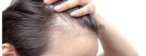 Alopecia androgenetica maschile: come capire se si è affetti Alopecia androgenetica maschile: come capire se si è affetti