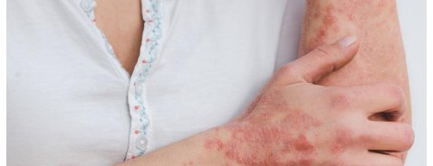 Quali sono i sintomi dell'artrite psoriasica? Quali sono i sintomi dell'artrite psoriasica?