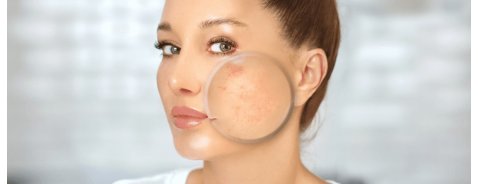 Come alleviare i sintomi dell'acne rosacea Come alleviare i sintomi dell'acne rosacea