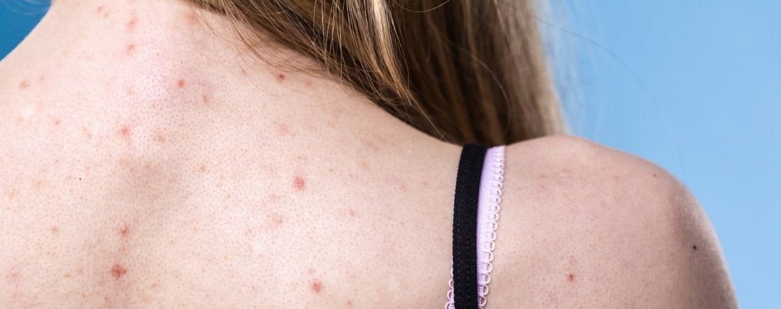 Come eliminare i brufoli sulla schiena: consigli e rimedi