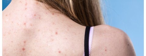 Come eliminare i brufoli sulla schiena: consigli e rimedi Come eliminare i brufoli sulla schiena: consigli e rimedi
