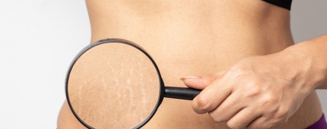 Come eliminare le smagliature rosse: rimedi e consigli utili