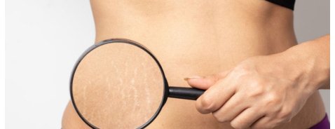 Come eliminare le smagliature rosse: rimedi e consigli utili Come eliminare le smagliature rosse: rimedi e consigli utili