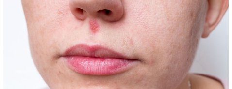 Come riconoscere l'herpes al naso e come curarlo Come riconoscere l'herpes al naso e come curarlo