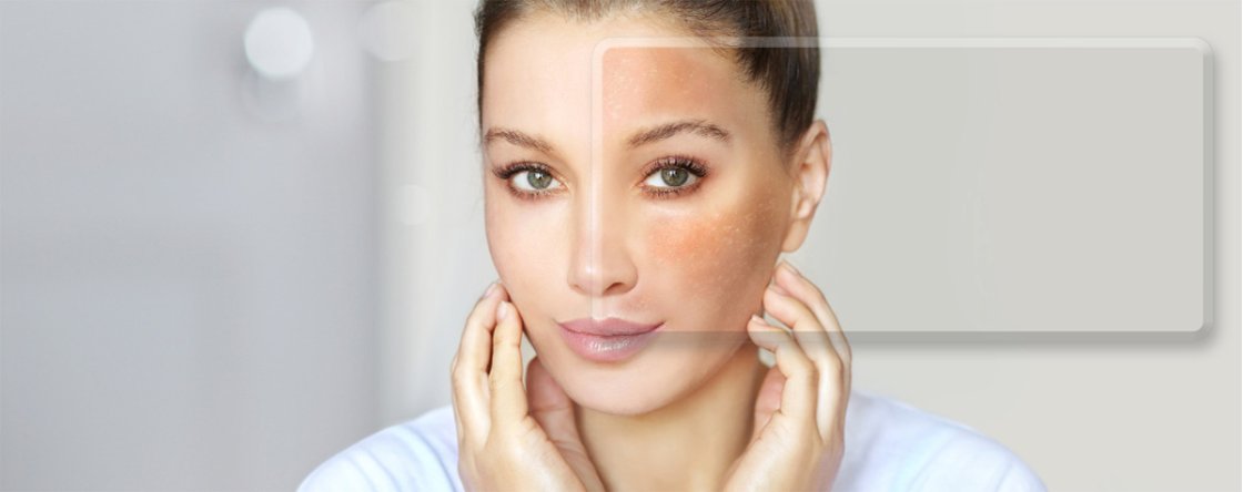 Pitiriasi Rosea è contagiosa? Cause, quanto dura, come si cura