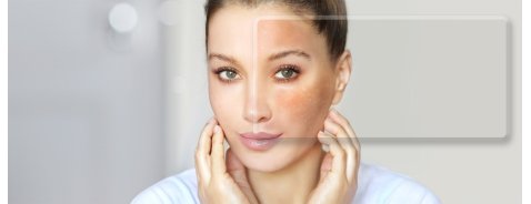 Pitiriasi Rosea è contagiosa? Cause, quanto dura, come si cura