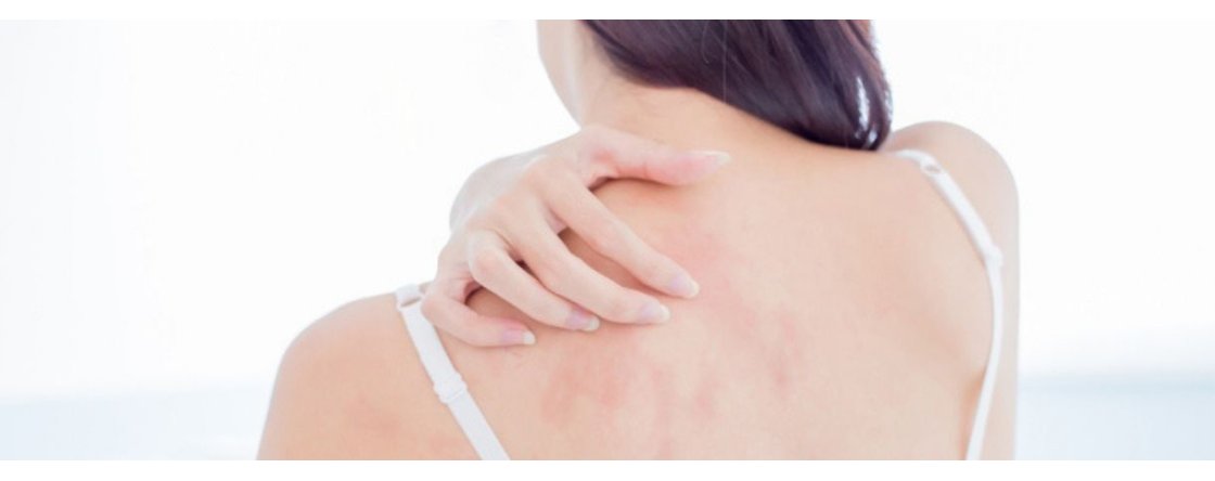 Come riconoscere uno sfogo cutaneo da stress?