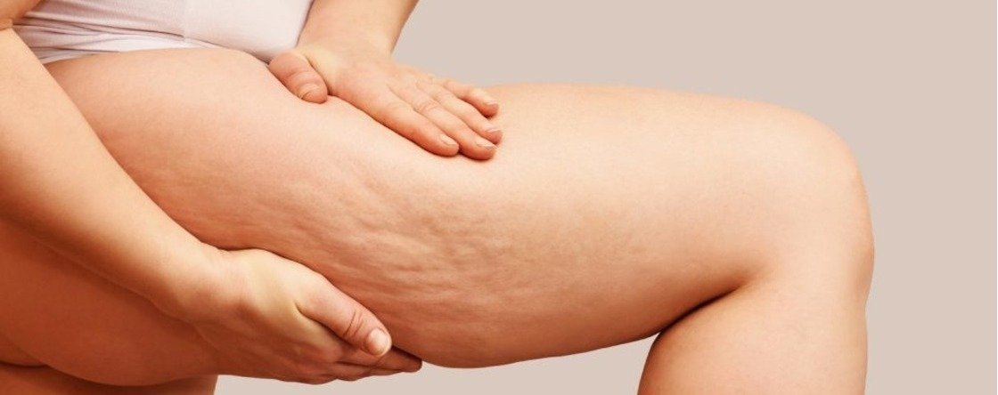 Quali sono i 4 stadi della cellulite?