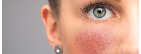 Come curare la dermatite seborroica del viso?