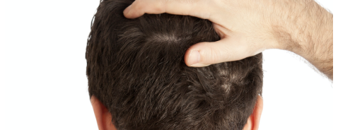 Che shampoo usare se soffri di dermatite seborroica Che shampoo usare se soffri di dermatite seborroica