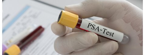 Valori PSA: cosa è, come si calcola, quando preoccuparsi Valori PSA: cosa è, come si calcola, quando preoccuparsi