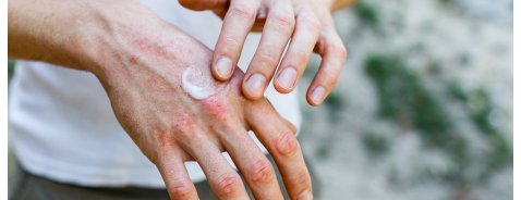 Quanto durano i geloni alle mani? Quanto durano i geloni alle mani?