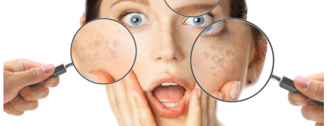 Macchie solari sul viso: cause, come prevenirle ed eliminarle